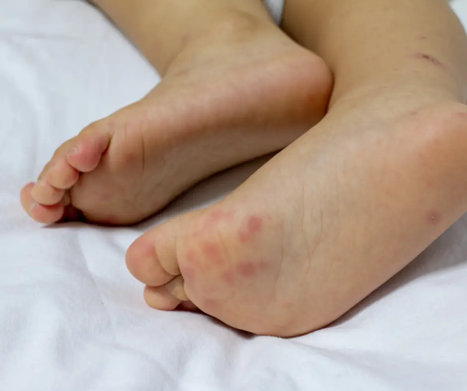 Child with HFM disease